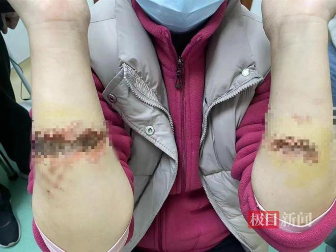 可怕!男子通马桶时双眼被灼伤几乎失明!这东西很多人家里都有(图4)